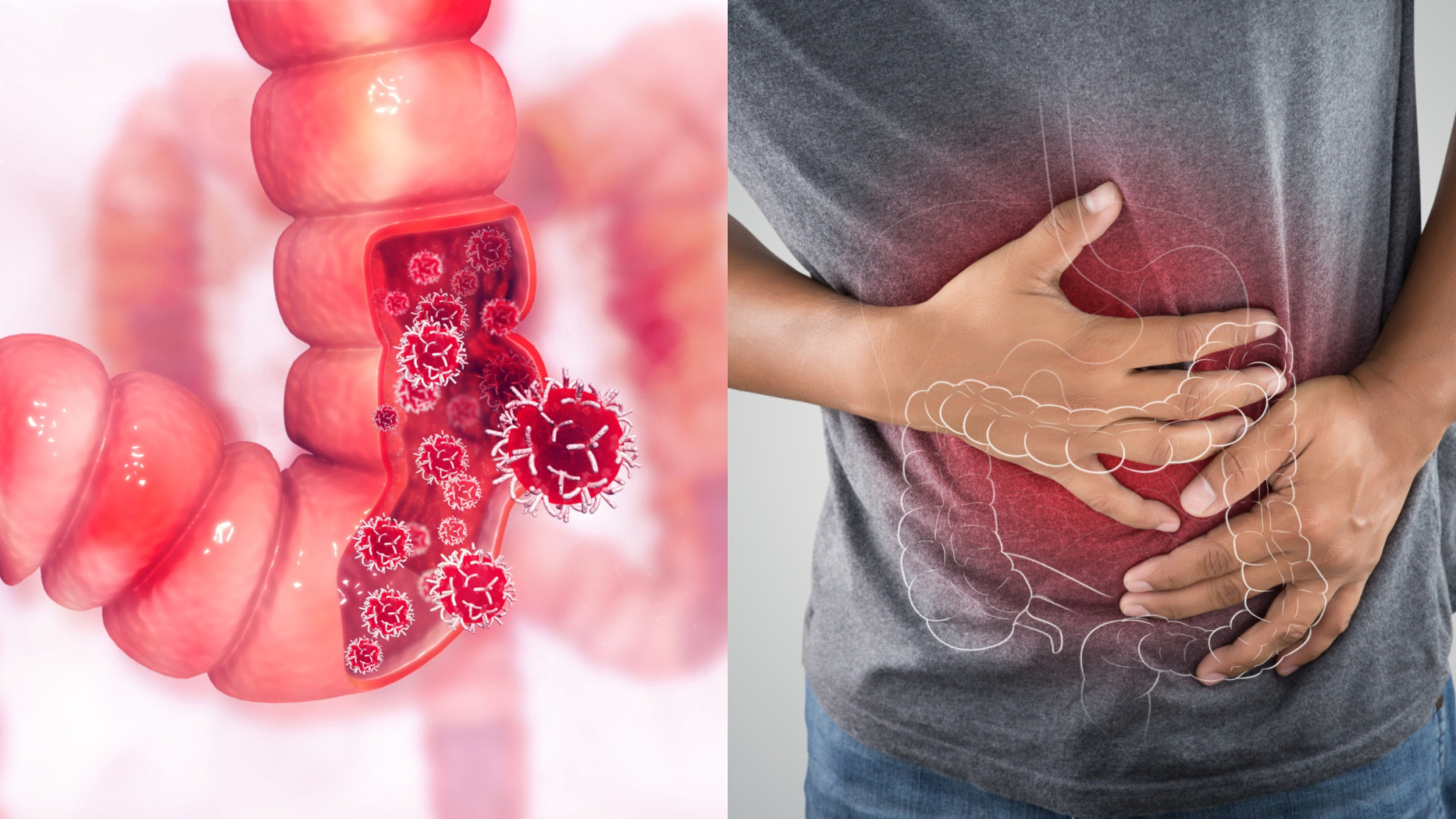 Câncer Colorretal Os Sintomas Silenciosos Da Perigosa Doença Portal